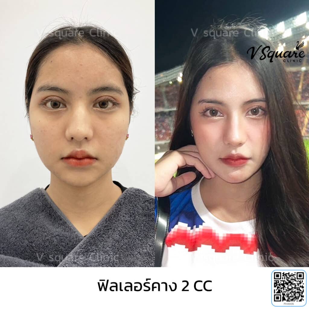 รีวิวฉีดฟิลเลอร์คาง_คุณปอปอ อินฟลู