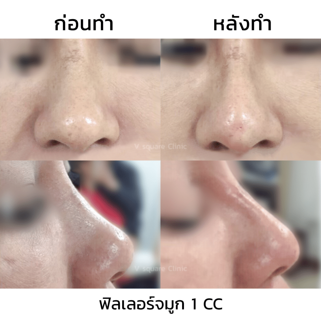 รีวิวฉีดฟิลเลอร์จมูก