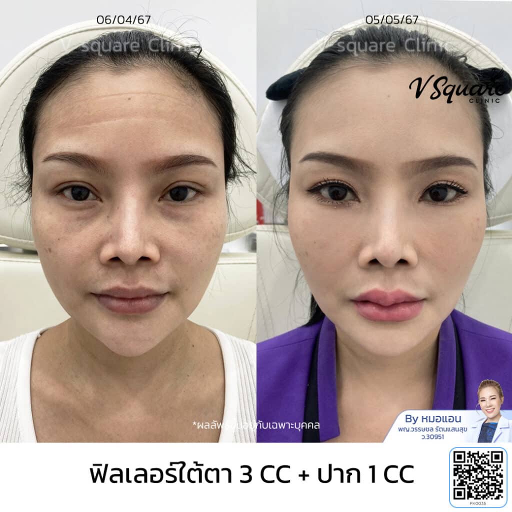 รีวิวฉีดฟิลเลอร์ปาก-ใต้ตา_คุณเขมิสรา โดย หมอ แอน
