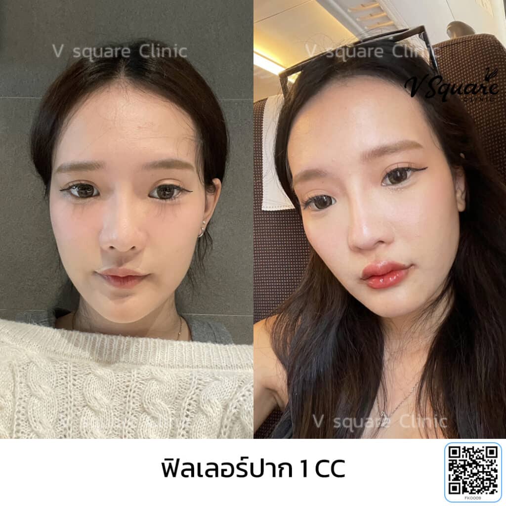 รีวิวฉีดฟิลเลอร์ปาก_คุณโมกุล อินฟลู