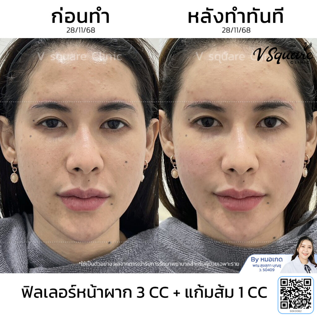 รีวิวฉีดฟิลเลอร์หน้าผาก_ไอริน โดย หมอเกด