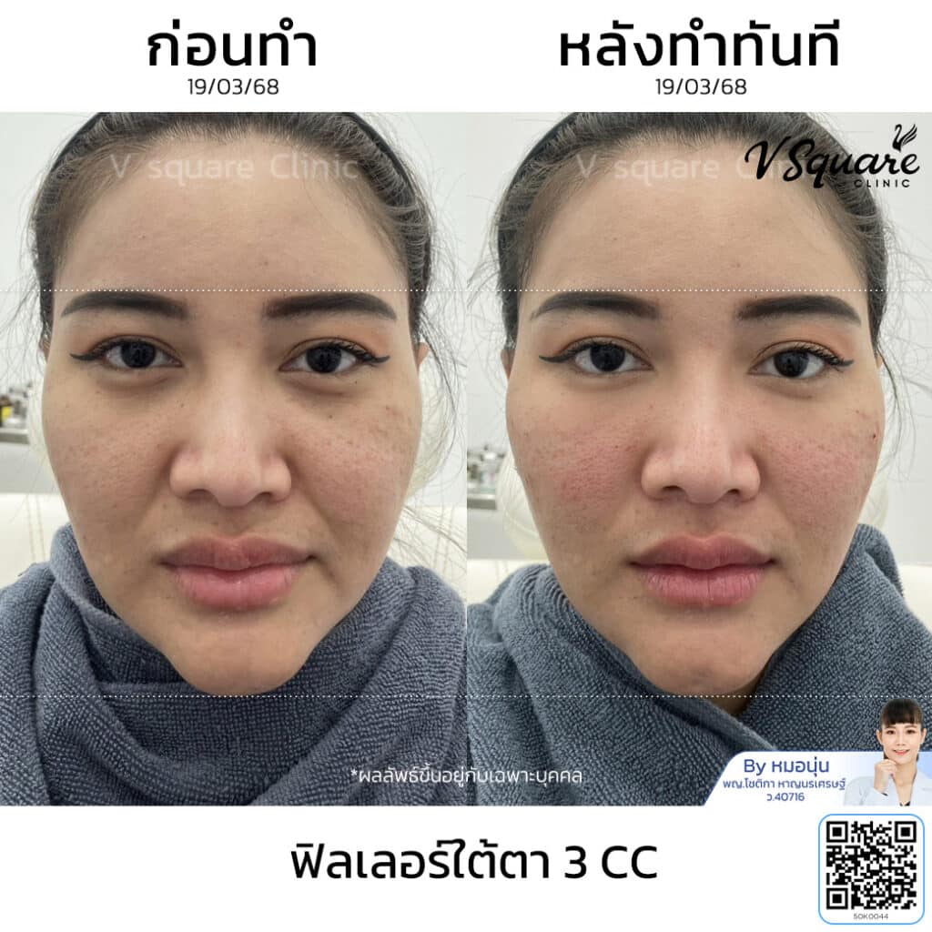 รีวิวฉีดฟิลเลอร์ใต้ตา_ณัฐธิดา โดย หมอ นุ่น