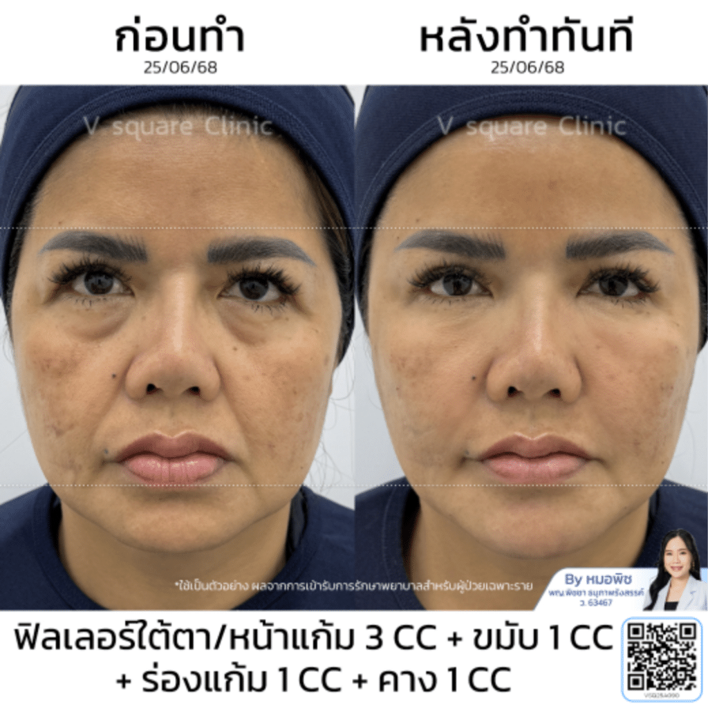 รีวิวฟิลเลอร์ขมับ 1 CC_คุณหนิง_โดยหมอพิช