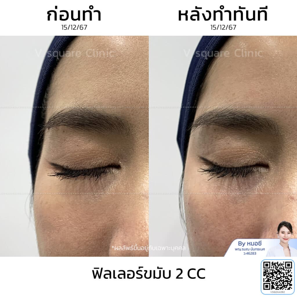 รีวิวฟิลเลอร์ขมับ_คุณกุ๊กกิ๊ก โดย หมอซี