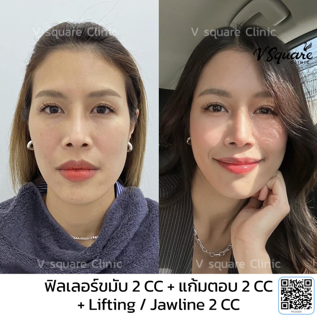 รีวิวฟิลเลอร์ขมับ_คุณต้นเตย อินฟลู