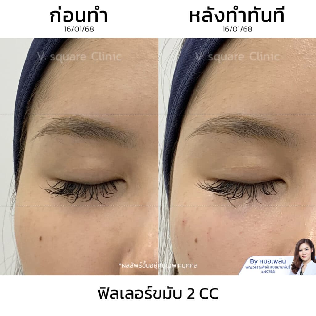 รีวิวฟิลเลอร์ขมับ_คุณเฟิร์น โดย หมอ เพลิน
