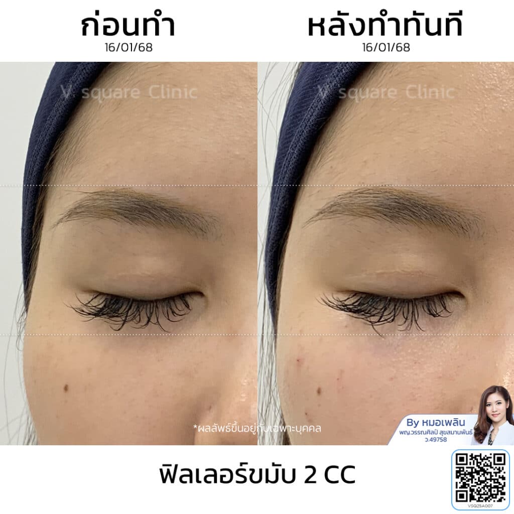รีวิวฟิลเลอร์ขมับ_คุณเฟิร์น_โดยหมอเพลิน