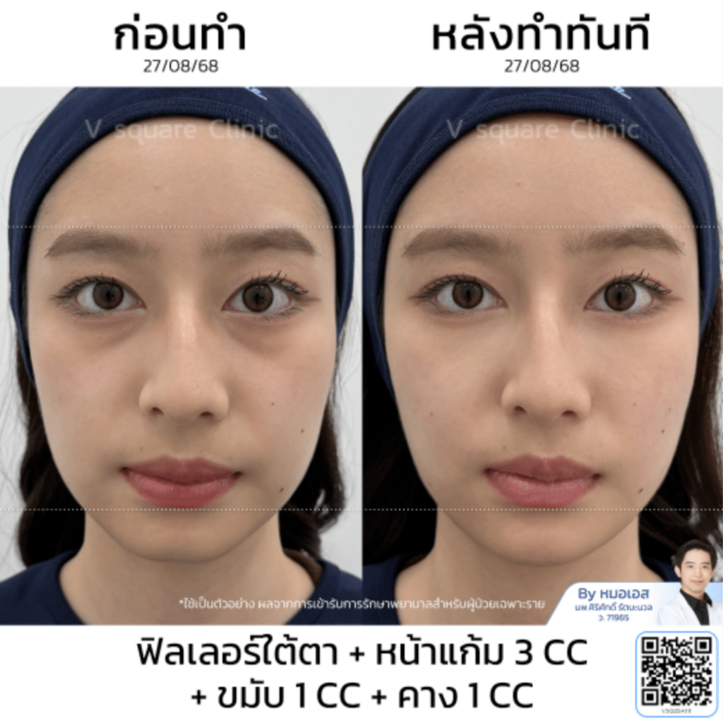 รีวิวฟิลเลอร์ขมับ_คุณแจกัน (แบบเบสๆ)_โดยหมอเอส