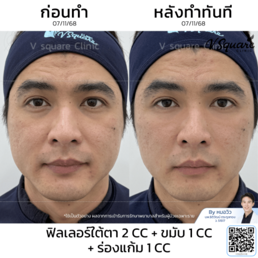รีวิวฟิลเลอร์ขมับ_คุณแม๊ก Influencer_โดยหมอวิว
