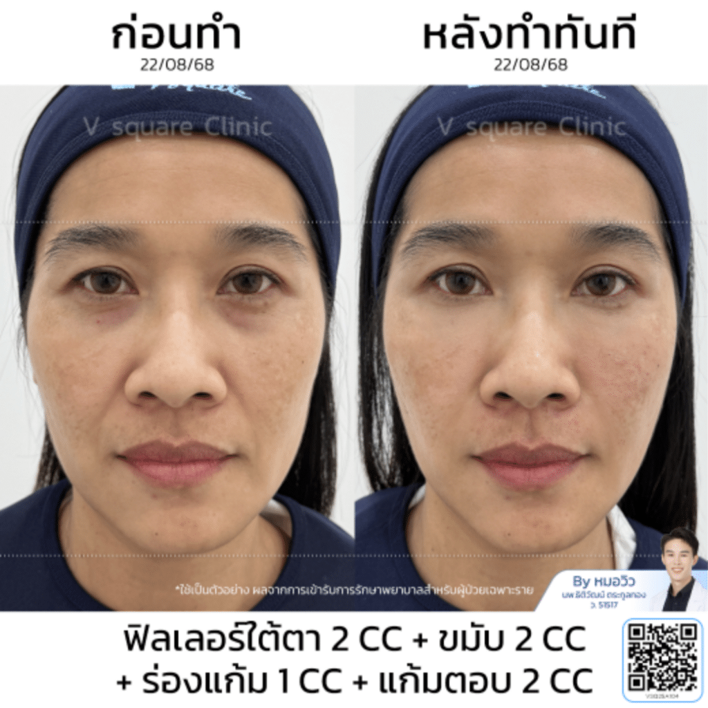 รีวิวฟิลเลอร์ขมับ_คุณแอน (แบบเบสๆ)_โดยหมอวิว