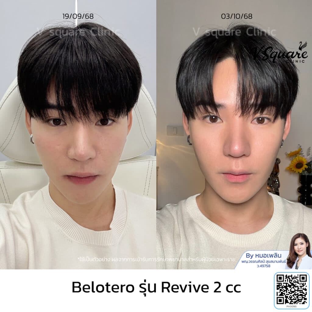 รีวิวฟิลเลอร์งานผิว Belotero Revive_คุณเซกิ โดย หมอเพลิน