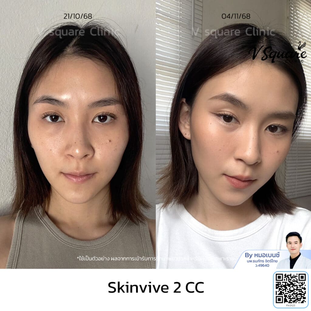 รีวิวฟิลเลอร์งานผิว Skinvive_คุณเอม FK โดย หมอเบนซ์