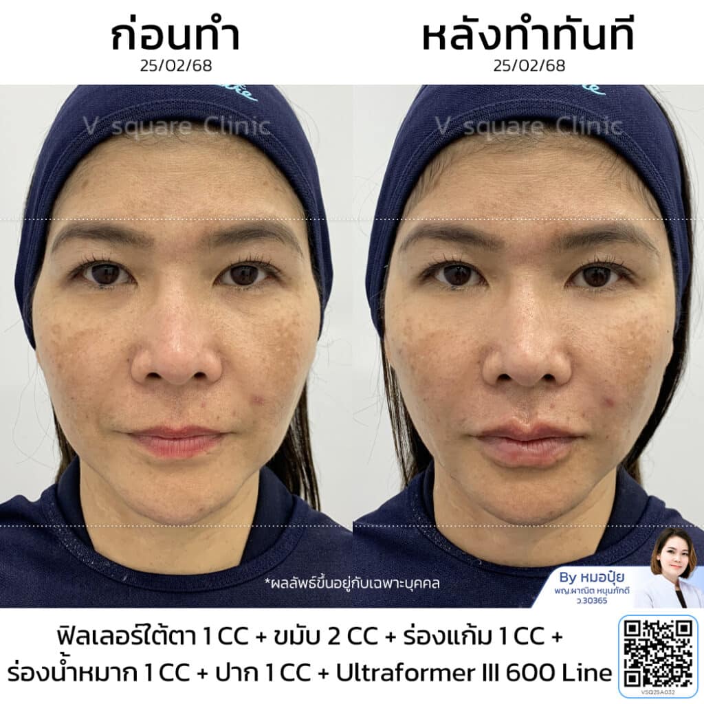 รีวิวฟิลเลอร์ร่องน้ำหมาก_คุณหมวย โดย หมอปุ๋ย