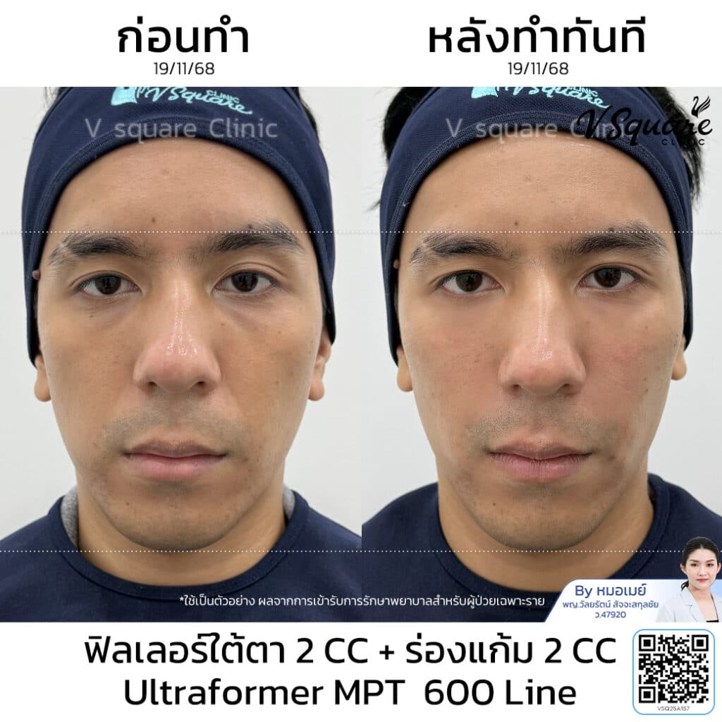 รีวิวฟิลเลอร์ร่องแก้ม ใต้ตา_คุณทีม Influencer โดย หมอเมย์