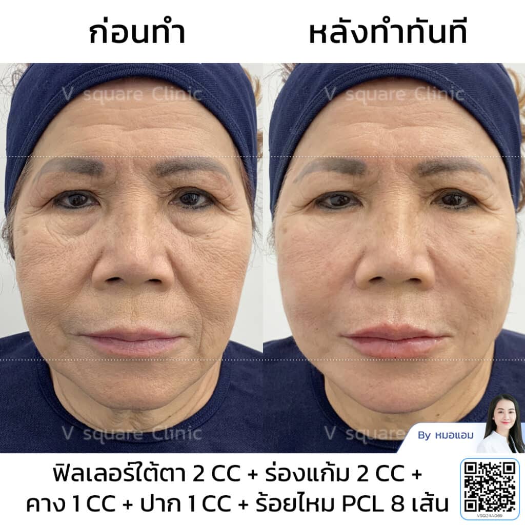 รีวิวฟิลเลอร์ร่องแก้ม_คุณหมวย โดย หมอแอม