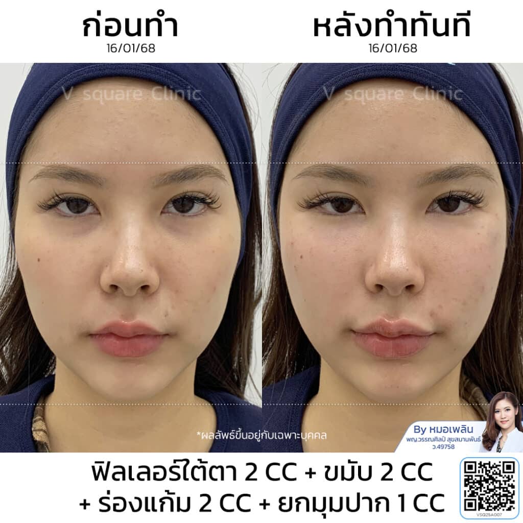 รีวิวฟิลเลอร์ร่องแก้ม_คุณเฟิร์น Influencer โดย หมอเพลิน