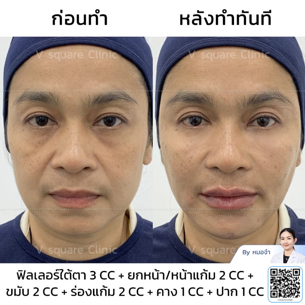 รีวิวฟิลเลอร์ใต้ตา_คุณกบ(แบบแบสๆ) โดย หมอจ๋า