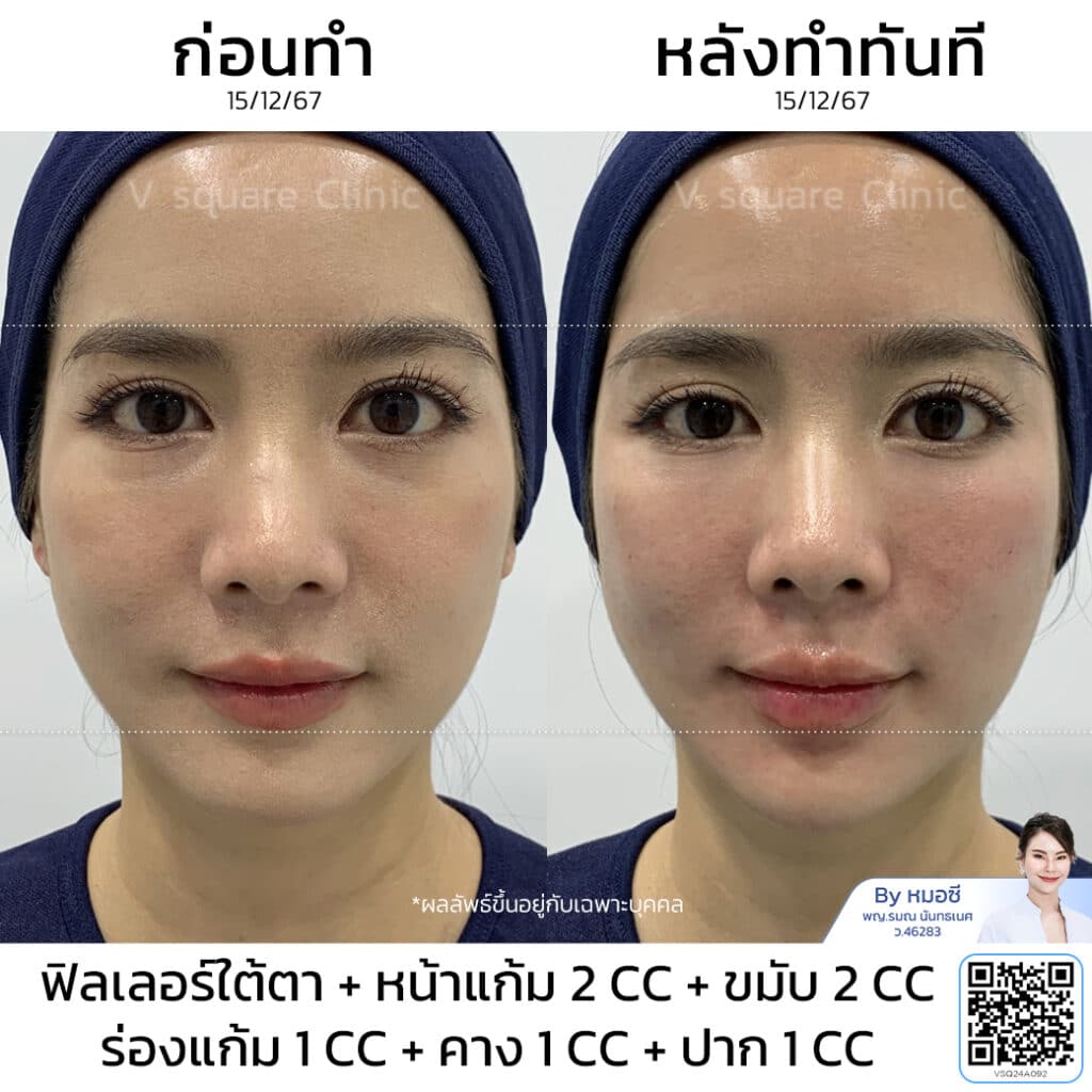 รีวิวฟิลเลอร์ใต้ตา_คุณกุ๊กกิ๊ก โดย หมอซี