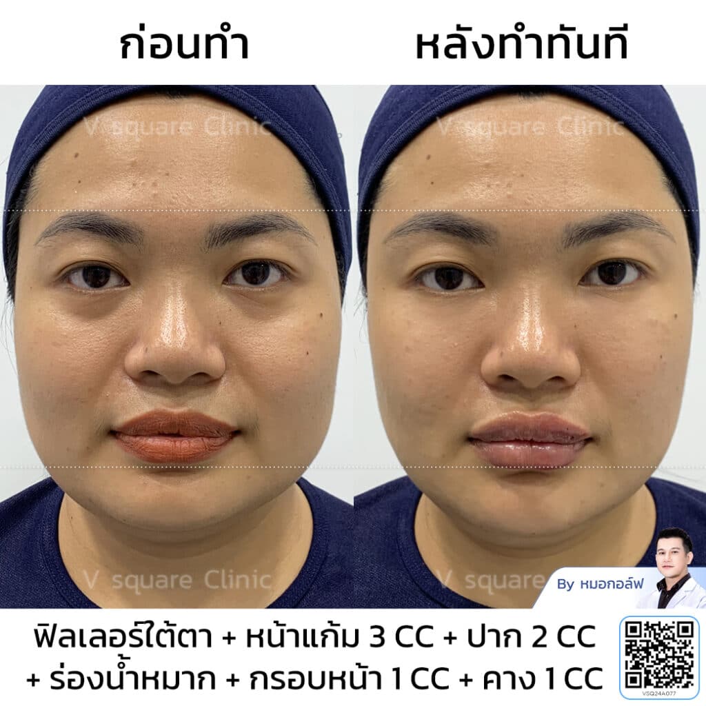 รีวิวร่องน้ำหมาก_คุณทราย โดย หมอ กอล์ฟ