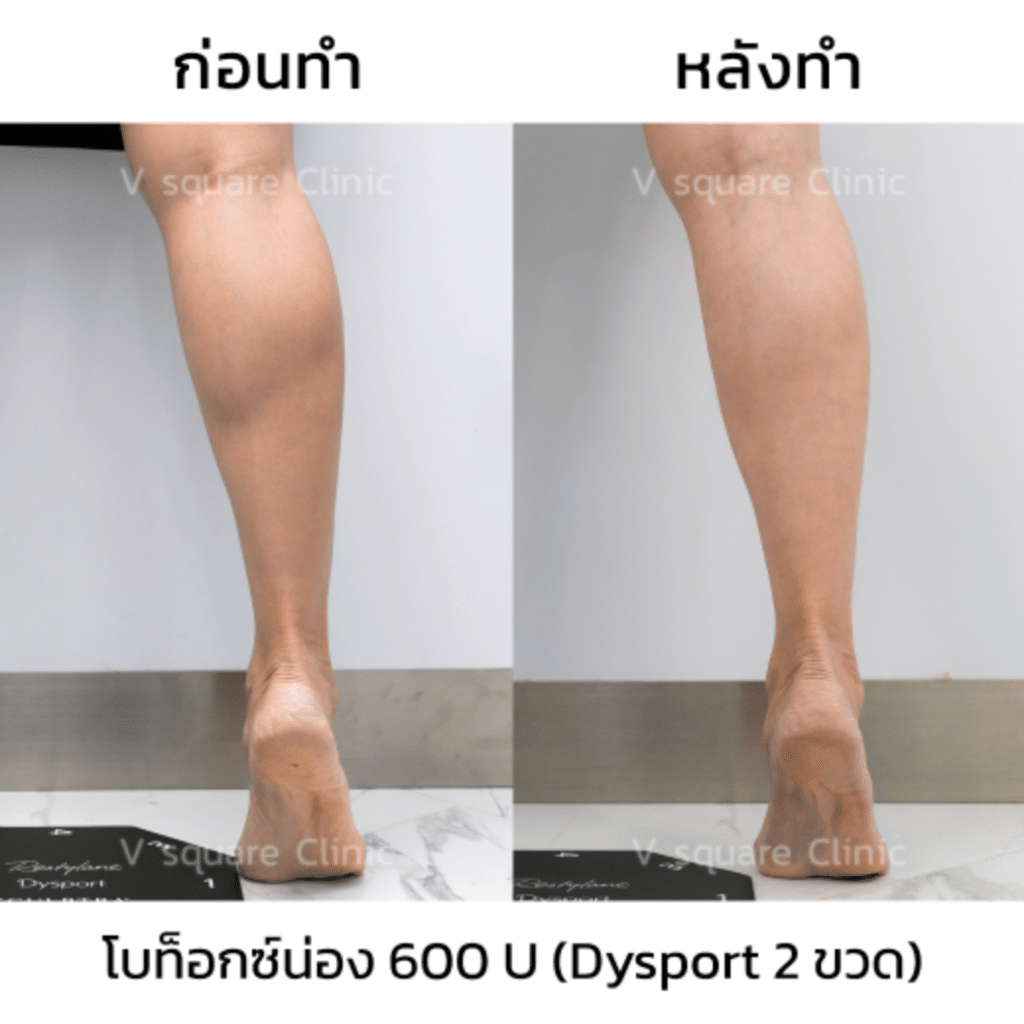 รีวิวโบท็อกน่อง_คุณแจน