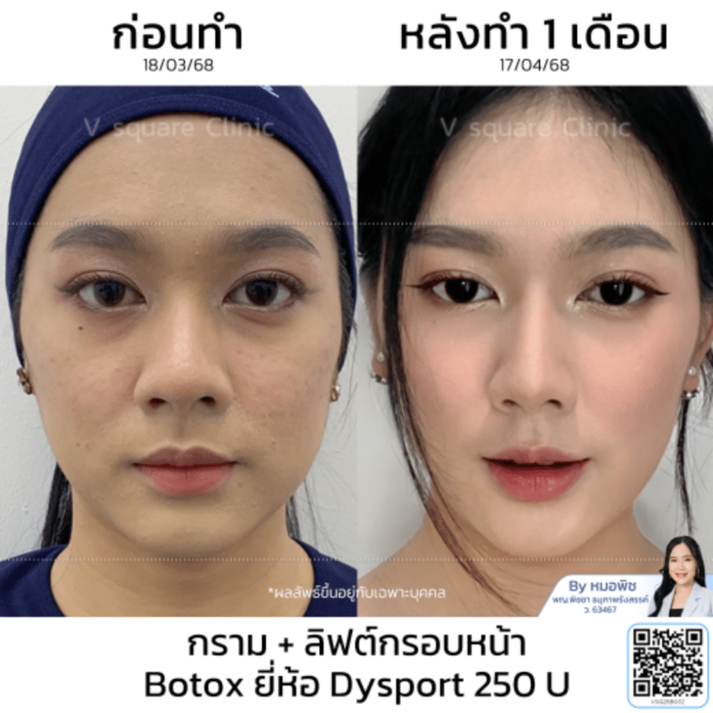 รีวิวโบท็อกกราม_คุณยาหยี_โดยหมอพิช