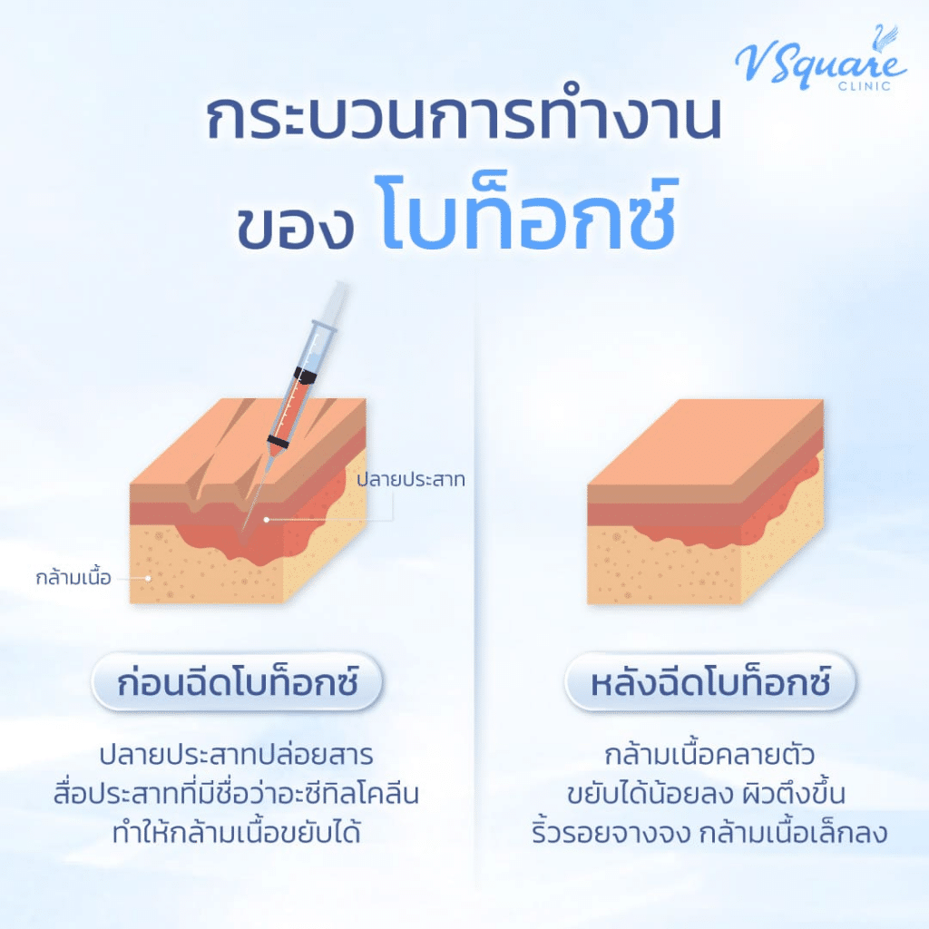 กระบวนการออกฤทธิ์ของโบท็อก