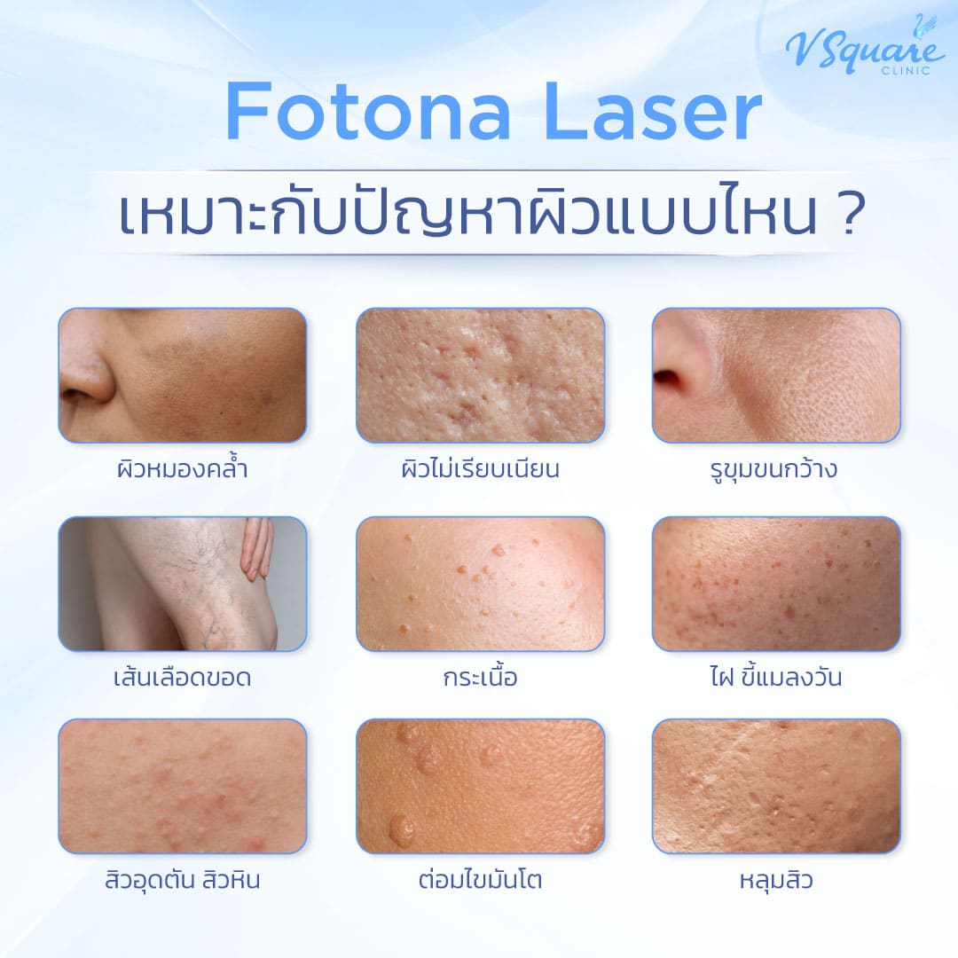 Fotona Laser เหมาะกับปัญหาผิวแบบไหน