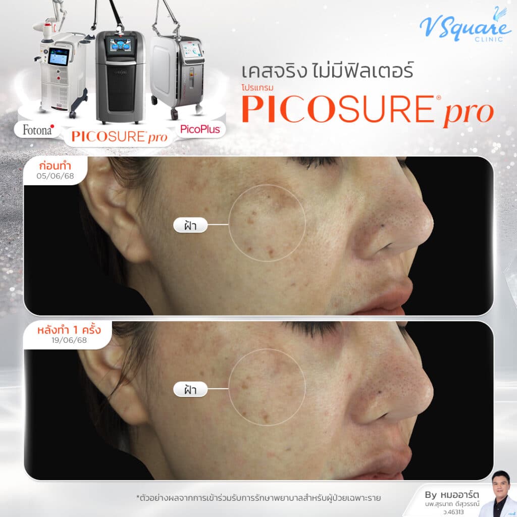 Pico Laser ฝ้า_คุณแพรวนภา