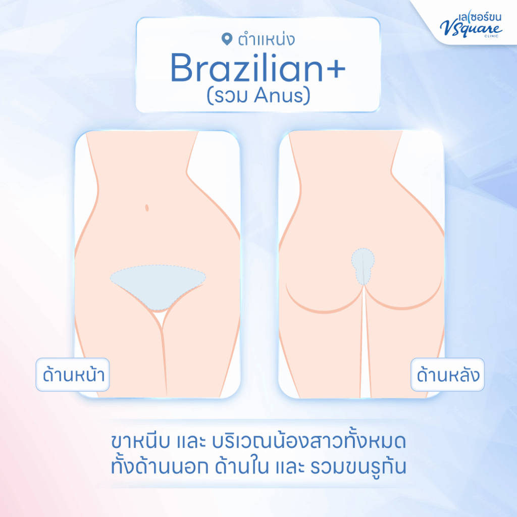 เลเซอร์บราซิลเลี่ยน