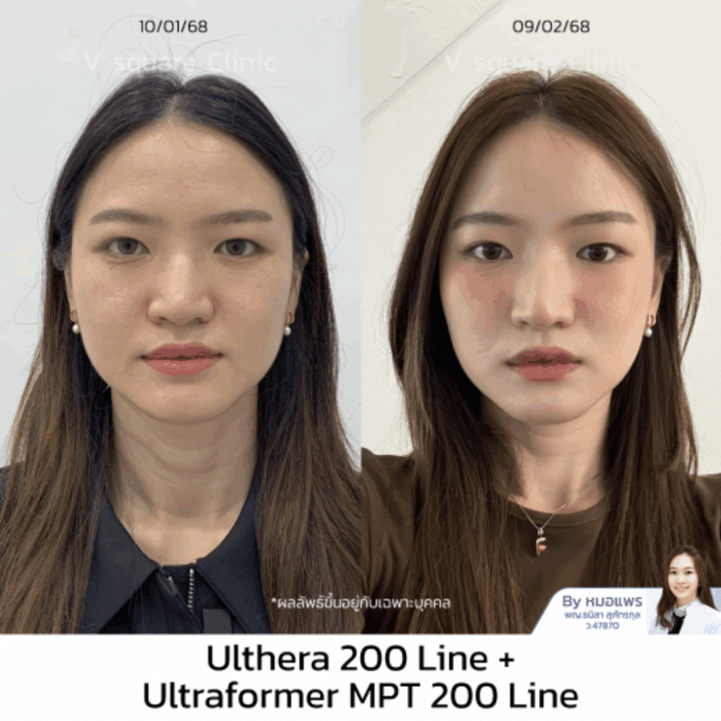 Ulthera ที่ไหนดี รีวิว Ulthera 200 line_ฟิว