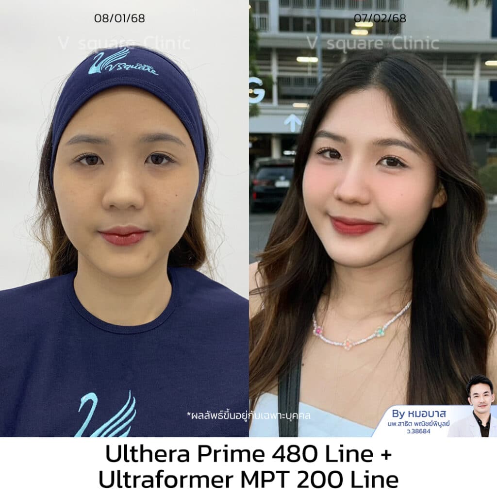 อัลเทอร่า ที่ไหนดี รีวิวอัลเทอร่า 300 ไลน์_เอิร์น UL RR+MPT