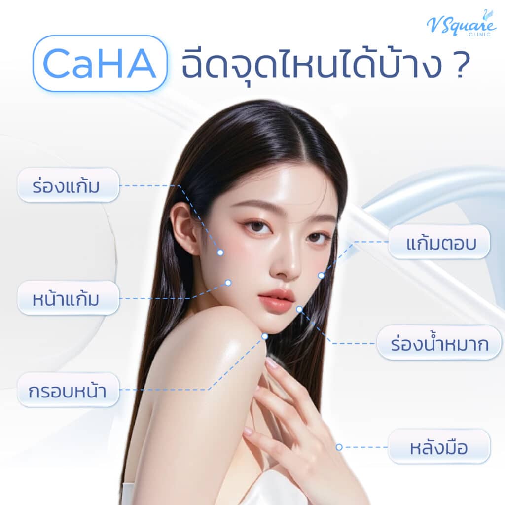 CaHA ฉีดจุดไหนได้บ้าง