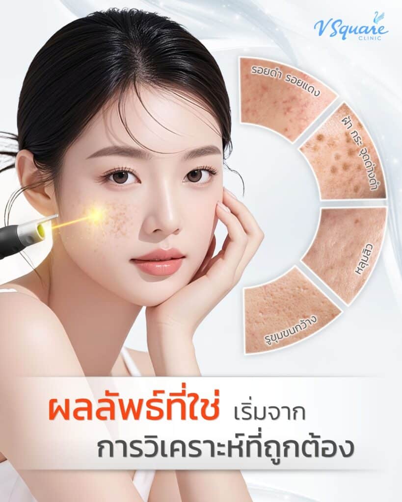 Picosure Pro ทั่วหน้า