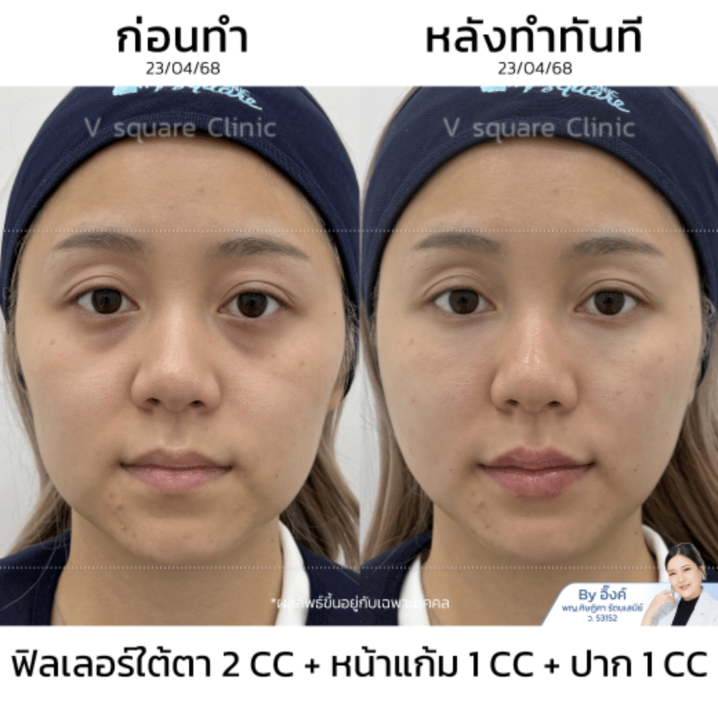 Restylane Vital Light รีวิว_คุณดอลลาร์