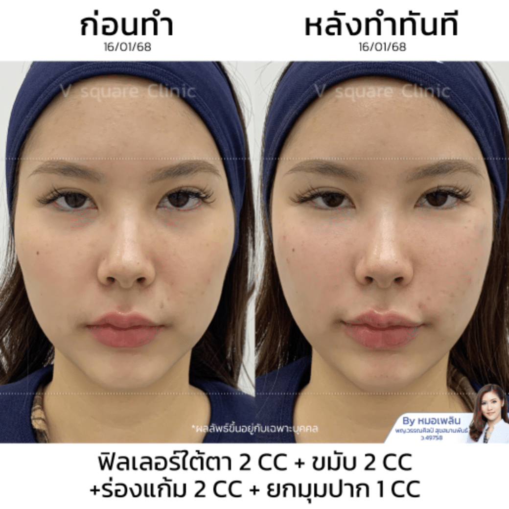 Restylane Vital Light รีวิว_คุณดอลลาร์(1)