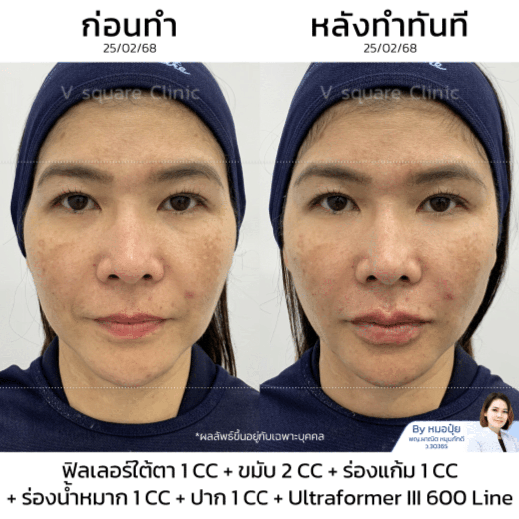 Restylane Vital Light รีวิว_คุณหมวย