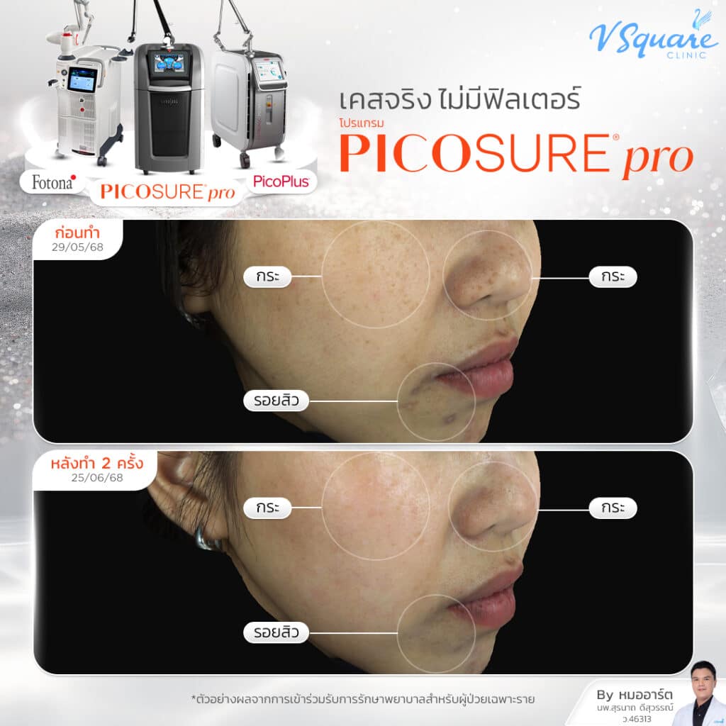 รีวิว Picosure Pro_คุณนัน