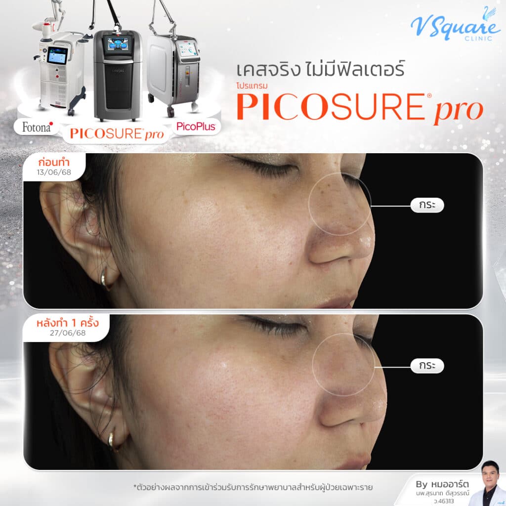 รีวิว Picosure Pro_คุณเป็ก