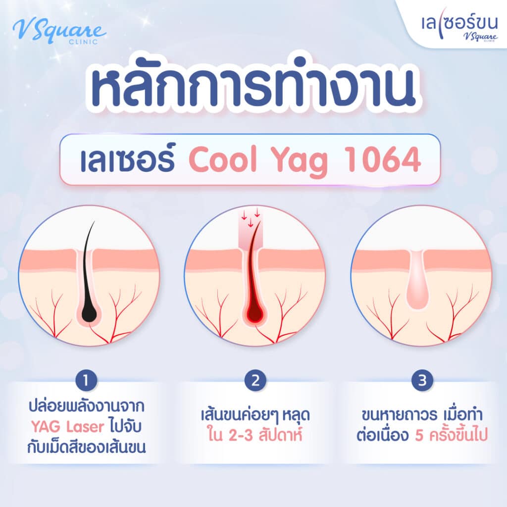 หลักการทำงานของเครื่องเลเซอร์ขน Cool Yag