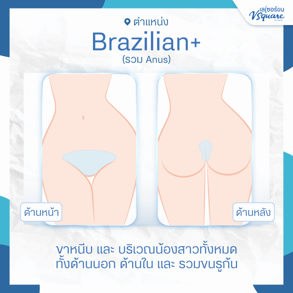 เลเซอร์บราซิลเลี่ยน+