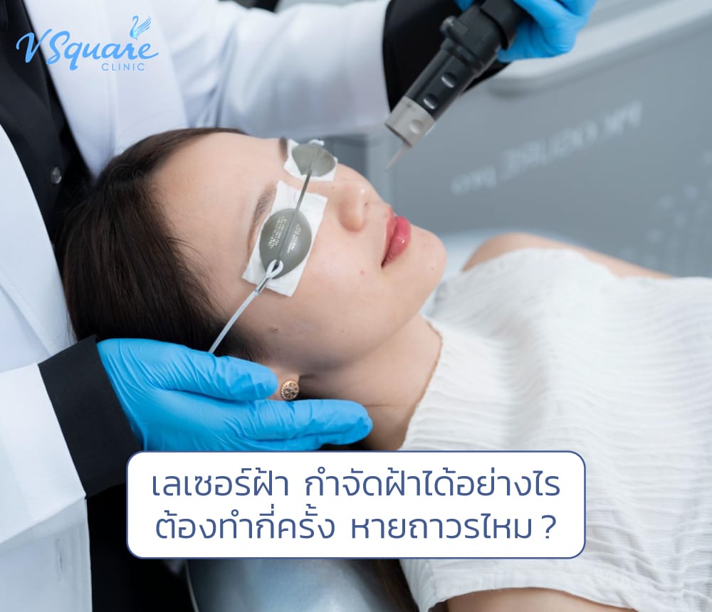 เลเซอร์ฝ้า