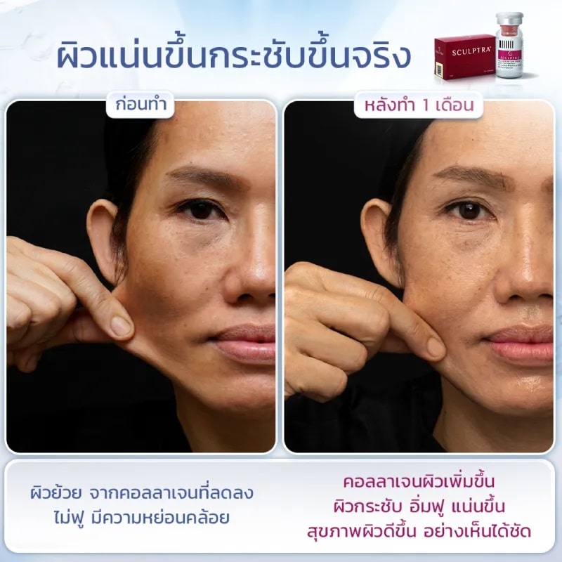 Sculptra รีวิว