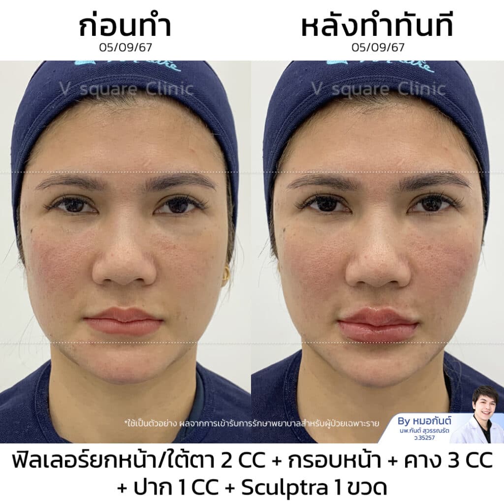 Sculptra รีวิว_ทนายนิด้า