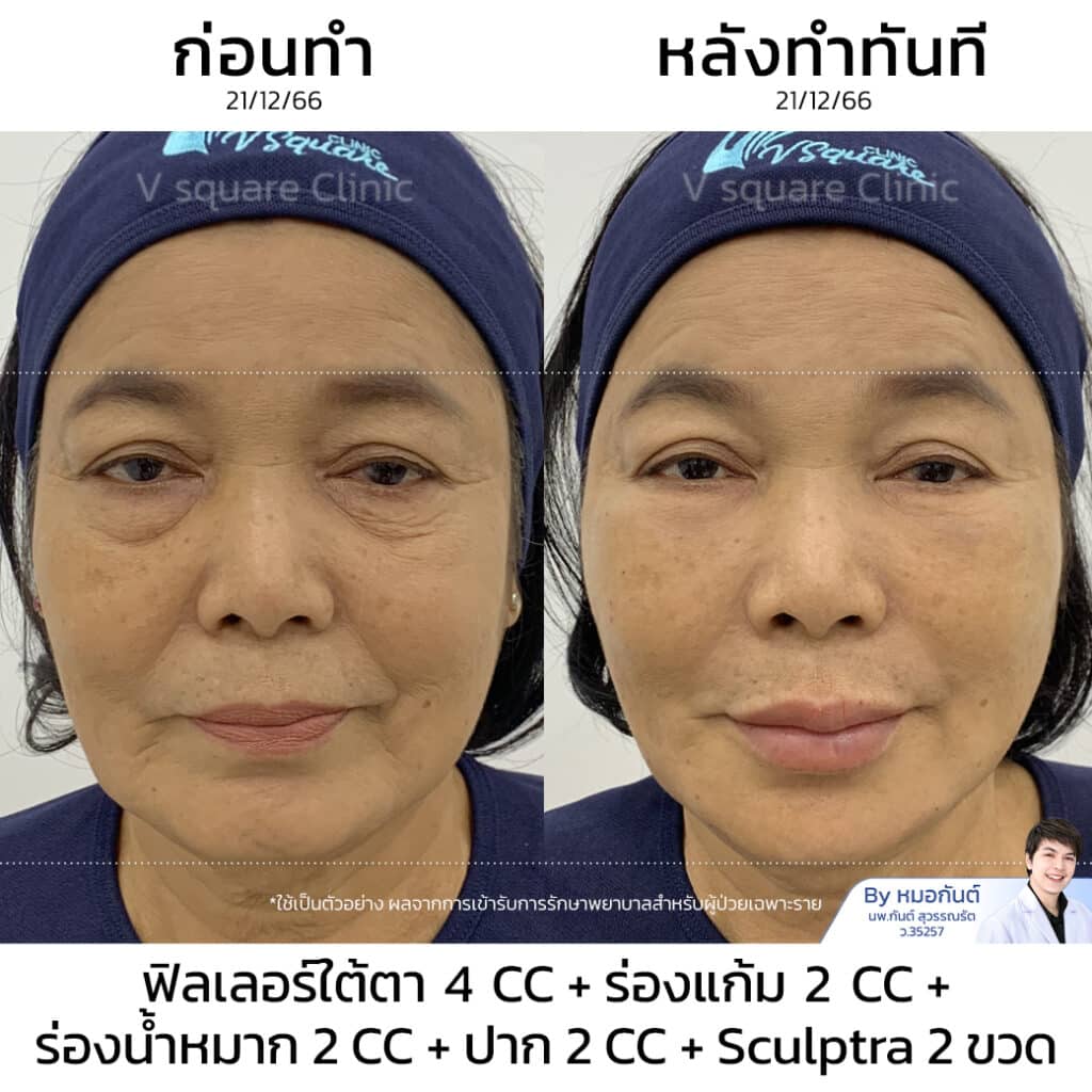 Sculptra รีวิว_แม่แรม