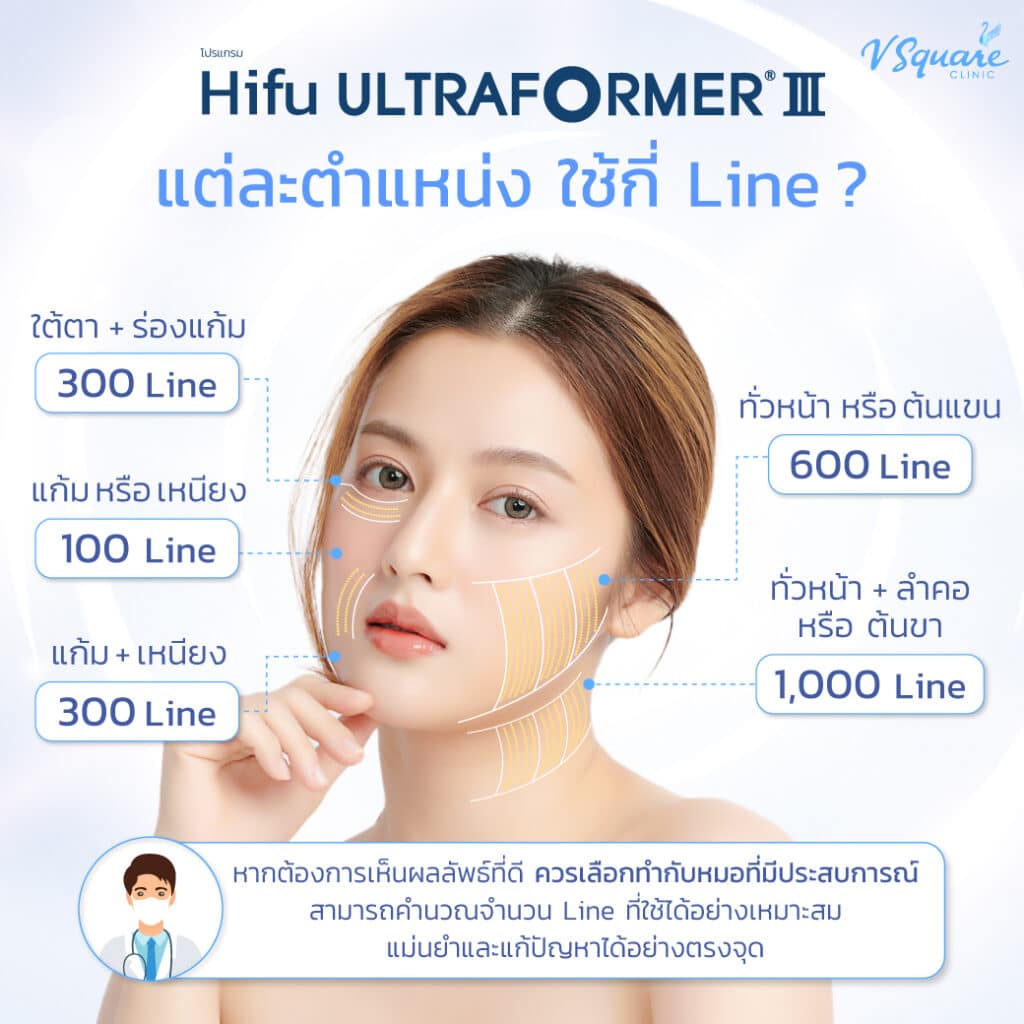 Ultraformer III แต่ละตำแหน่งใช้กี่ไลน์