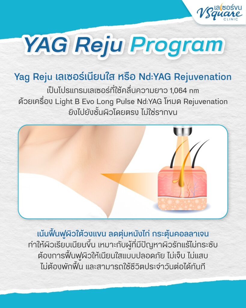 Yag Reju คืออะไร