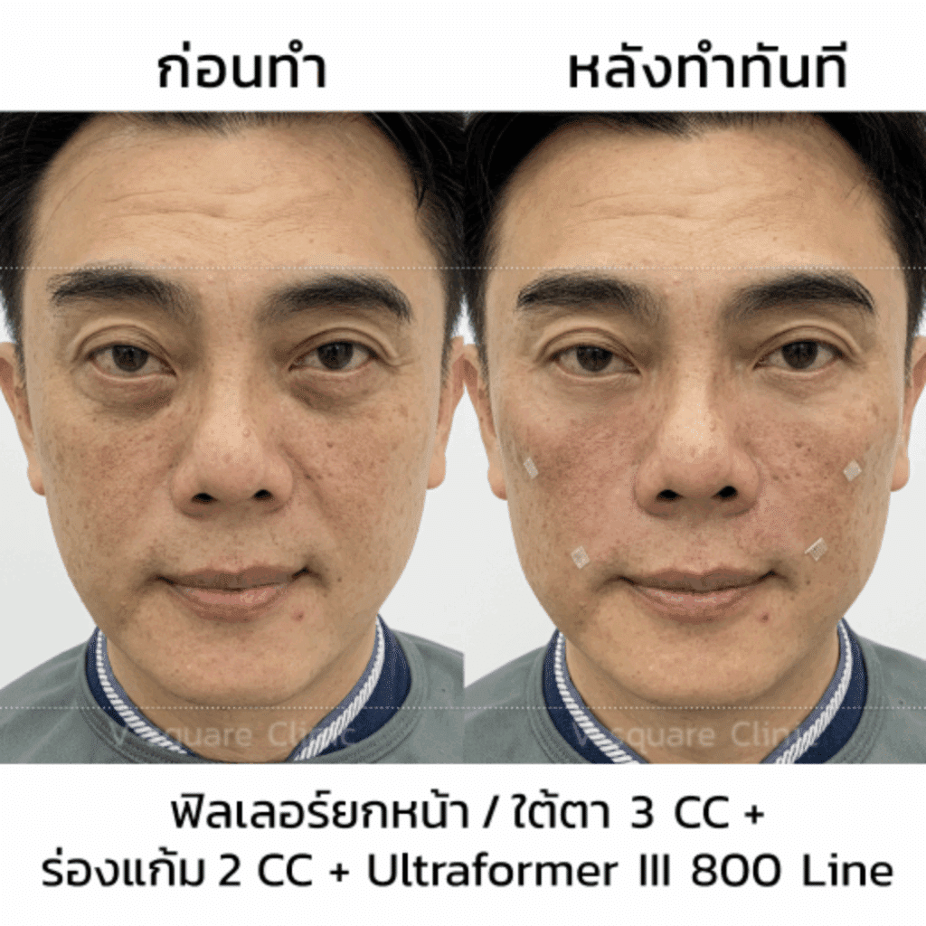 รีวิว Hifu เคสหมอเบนซ์_คุณเก่ง