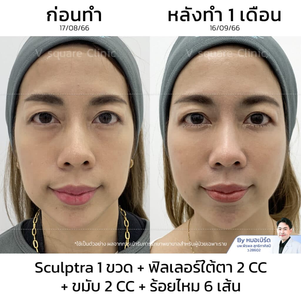 รีวิว Sculptra_คุณเกรซ