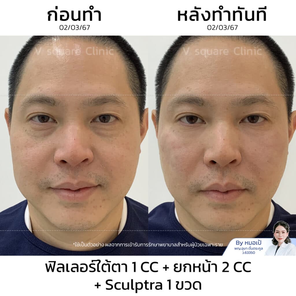 รีวิว Sculptra_หมอเส
