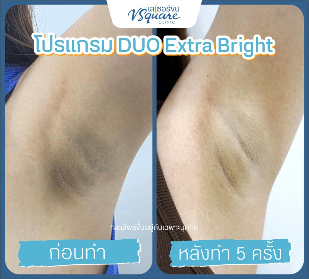 รีวิวผลลัพธ์ Yag Reju Duo Extra Bright ก่อนทำ-หลังทำ